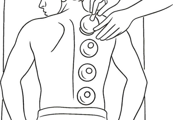 Application of Cups and Suction